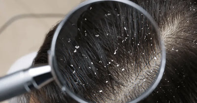 why is everyone talking about scalp health?